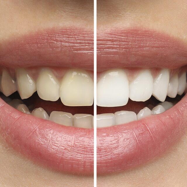 Clareamento Dental