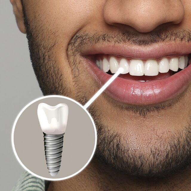 Implantes Dentários