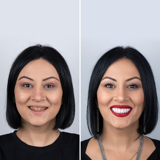 Lentes de Contato Dental
